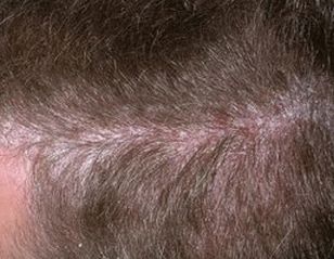 Хвороба псоріаз волосистої частини і шкіри голови, фото початковій стадії