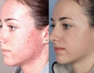 Фото шкіри обличчя після лікування псоріазу